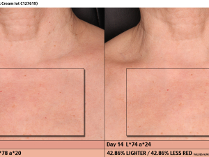 DEC01 Neck Cream Baseline, Day 14 PhGx