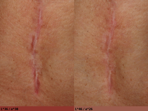 SCA01 scar reduction